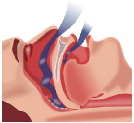 Obstructive sleep apnea