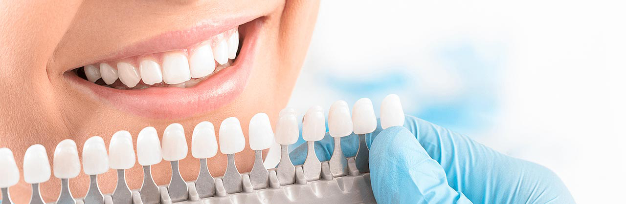 Veneers